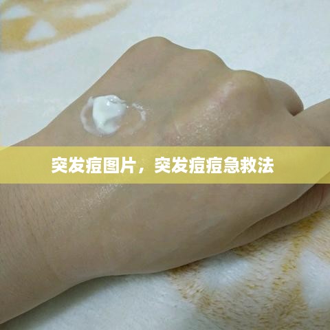 突发痘图片，突发痘痘急救法 