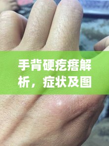 手背硬疙瘩解析，症状及图片参考，百度健康收录